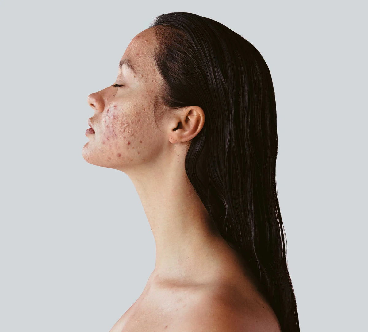 Acne Care